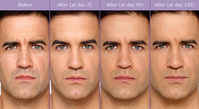 botox, botox cosmetic, male botox, before and after, wrinkles, antiaging